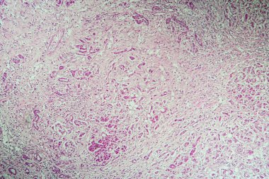 Mikroskop altında karaciğer sirozu hastalıklı doku 100 kat