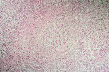 Mikroskop altında karaciğer sirozu hastalıklı doku 100 kat