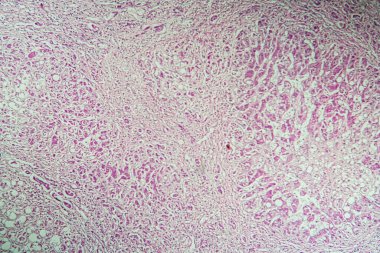 Mikroskop altında karaciğer sirozu hastalıklı doku 100 kat