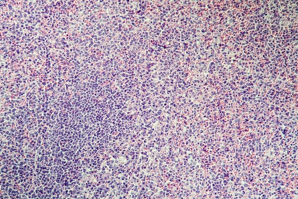 Brûlure Gaz Tissu Hépatique Malade Microscope 100X — Photo