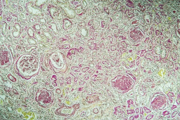显微镜下100X下萎缩肾病组织 — 图库照片