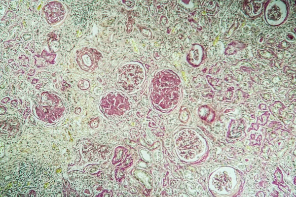 Geschrumpftes Nierengewebe Unter Dem Mikroskop 100X — Stockfoto