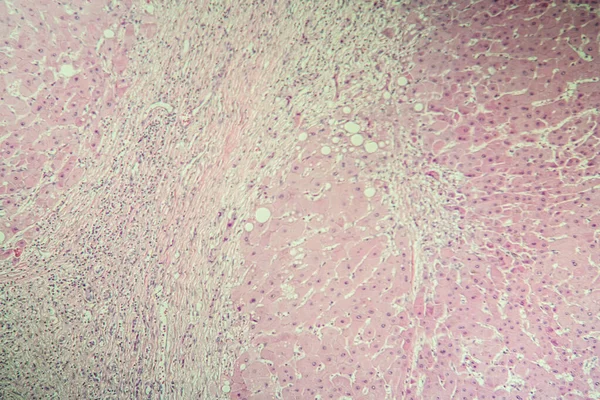 Cirrhose Foie Tissu Malade Sous Microscope 100X — Photo