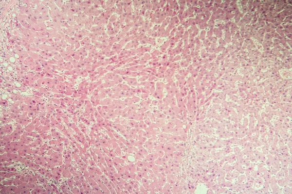 Cirrhose Foie Tissu Malade Sous Microscope 100X — Photo