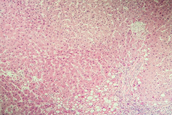 Cirrosis Hepática Tejido Enfermo Bajo Microscopio 100X —  Fotos de Stock