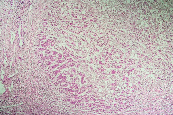 Cirrose Hepática Tecido Doente Microscópio 100X — Fotografia de Stock