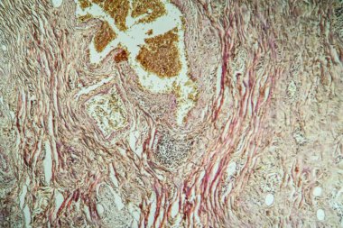 Divertikülü kolon dokusu 100x