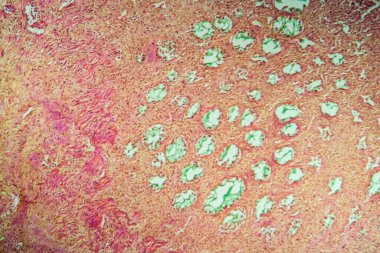 Divertikülü kolon dokusu 100x