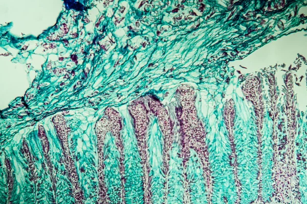 Tecido Câncer Cólon Sob Microscópio 100X — Fotografia de Stock