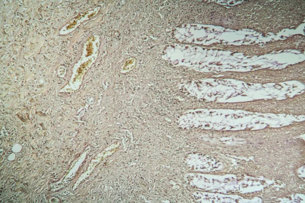 Colon tissue with diverticulum 100x