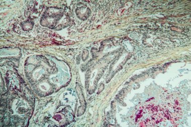 Kolon kanseri dokusu İnce bölüm 100x