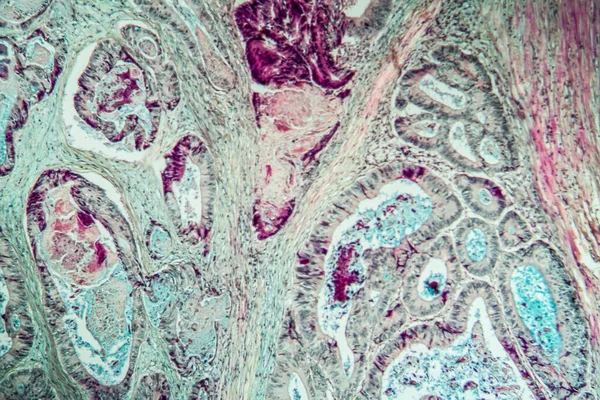 Carcinoma Del Colon Tessuto Sezione Sottile 100X — Foto Stock