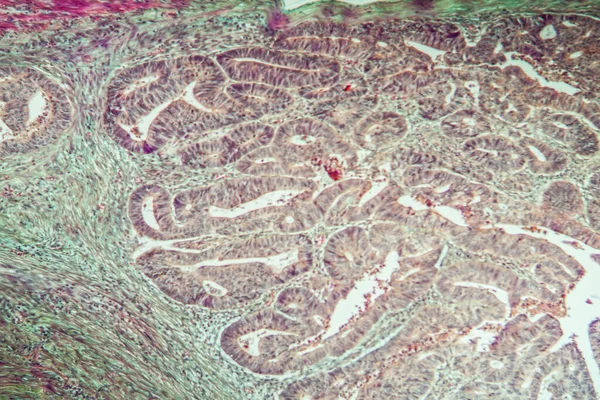 結腸がん組織薄部100X — ストック写真