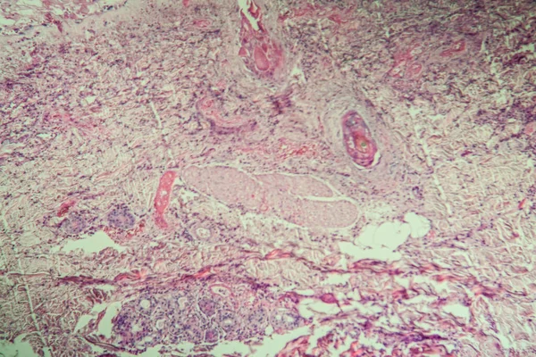 100X显微镜下的水痘感染组织 — 图库照片