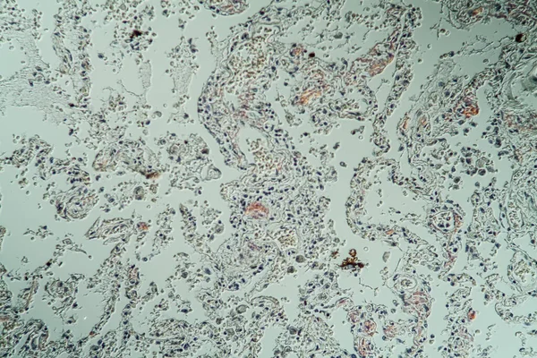 Lungen Mit Amyloid Ablagerungen Kranken Gewebes Unter Dem Mikroskop 200X — Stockfoto