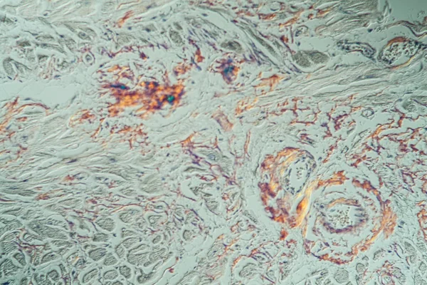 Krb Amyloidními Usazeninami Nemocné Tkáně Pod Mikroskopem 200X — Stock fotografie