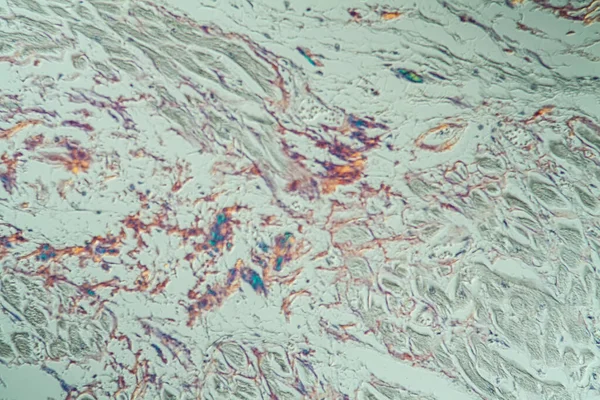 Εστία Αμυλοειδείς Εναποθέσεις Άρρωστου Ιστού Κάτω Από Μικροσκόπιο 200X — Φωτογραφία Αρχείου