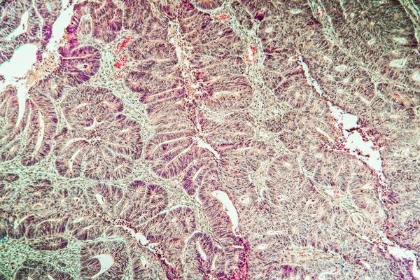 Colon Carcinoma Arising Adenoma 100X — Stock Photo, Image