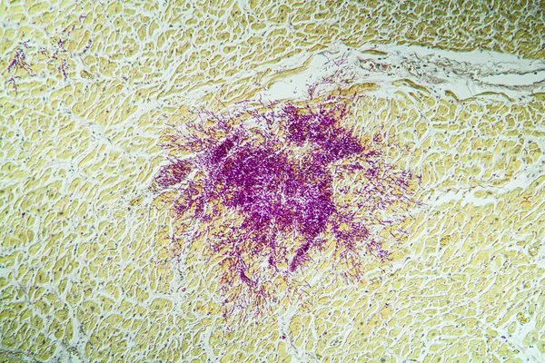 Candida in the heart muscle of an AIDS patient, 100x