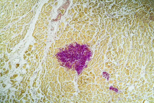 Candida in the heart muscle of an AIDS patient, 100x