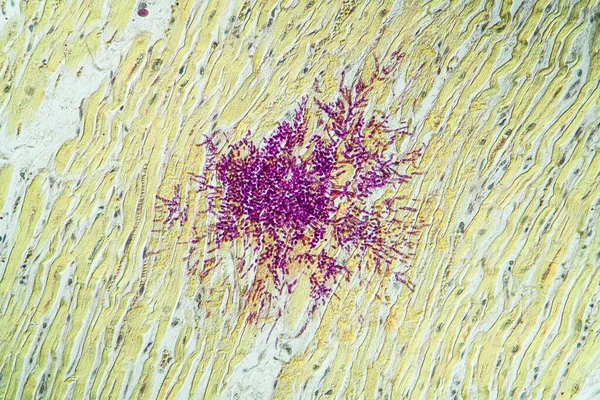 Candida in the heart muscle of an AIDS patient, 100x
