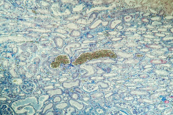 Depósitos Fibrina Riñón Microscopía 100X —  Fotos de Stock