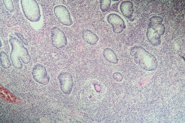 Crohn hastalığında kolon iltihabı. 100 kat.