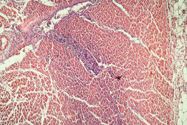 Enfarktüsten sonra kalp kası, doku bölümü 100x