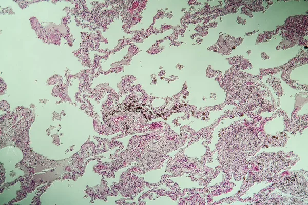 Tessuto Polmonare Come Polmone Polvere Microscopio 100X — Foto Stock