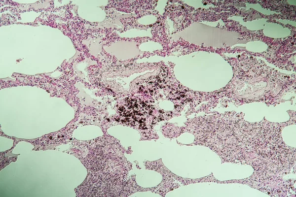 Tissu Pulmonaire Comme Poumon Poussière Sous Microscope 100X — Photo