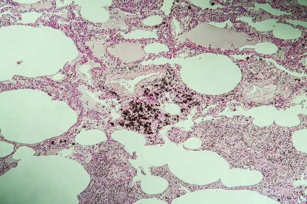 현미경 먼지로 폐조직 100X — 스톡 사진