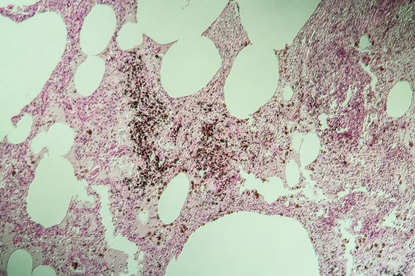 Tkanka Płucna Jako Płuco Kurzu Pod Mikroskopem 100X — Zdjęcie stockowe