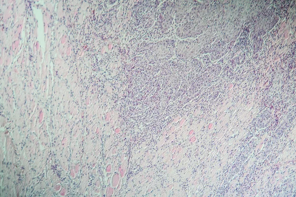 Carcinoma Úlcera Piel Agrandado 100X — Foto de Stock