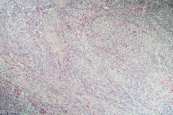 Carcinoma Úlcera Pele Aumentado 100X — Fotografia de Stock