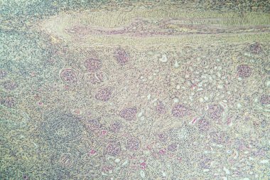 Doku bölümünde hidronefrozlu böbrek iltihabı 100x