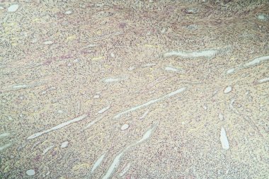 Doku bölümünde hidronefrozlu böbrek iltihabı 100x