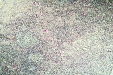 Doku bölümünde hidronefrozlu böbrek iltihabı 100x