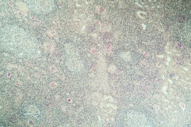 Doku bölümünde hidronefrozlu böbrek iltihabı 100x