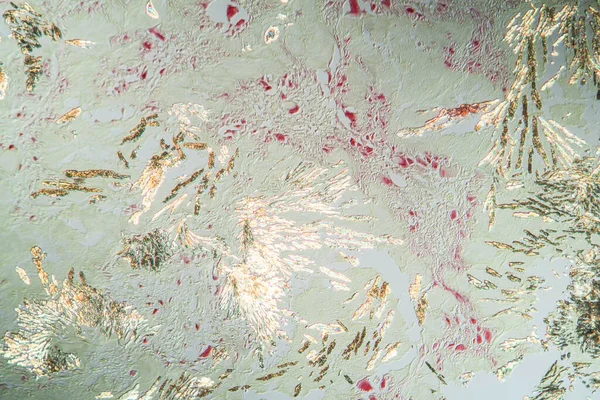 Hücrelerin Doku Bölümünde Artrit Gut Kristalleri 100X — Stok fotoğraf