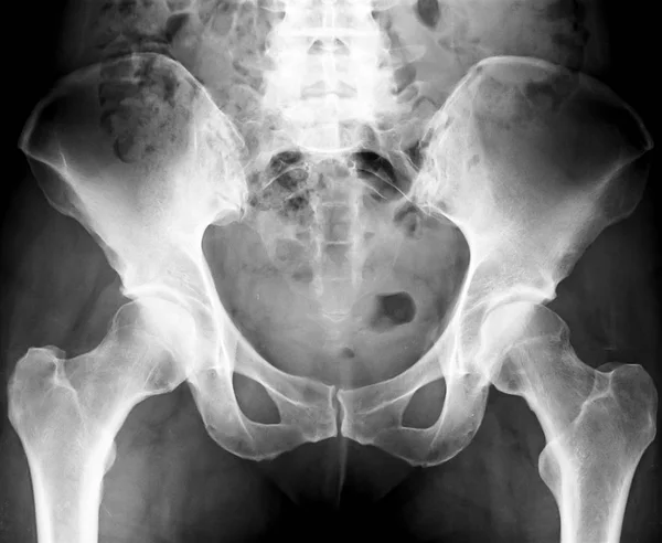 Pelvis X-Ray — Stock Photo, Image