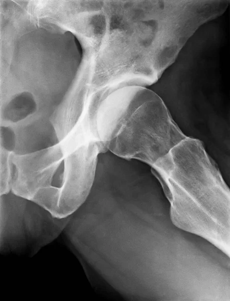 X-Ray of female Left Hip — Stock Photo, Image