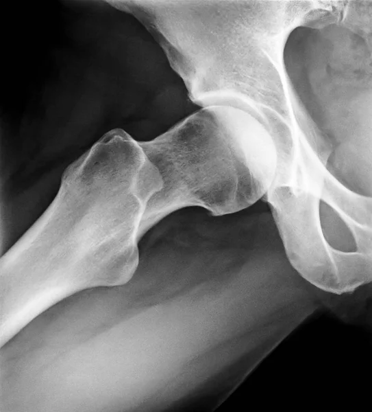 X-Ray of female Right Hip — Stock Photo, Image