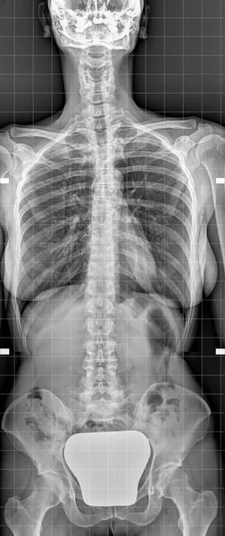 Рентген позвоночника женщины — стоковое фото
