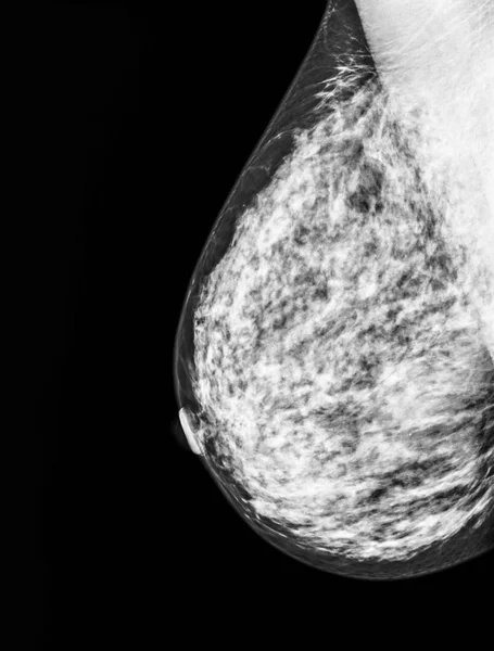 Mammography, x-ray of Breast — Stock Photo, Image