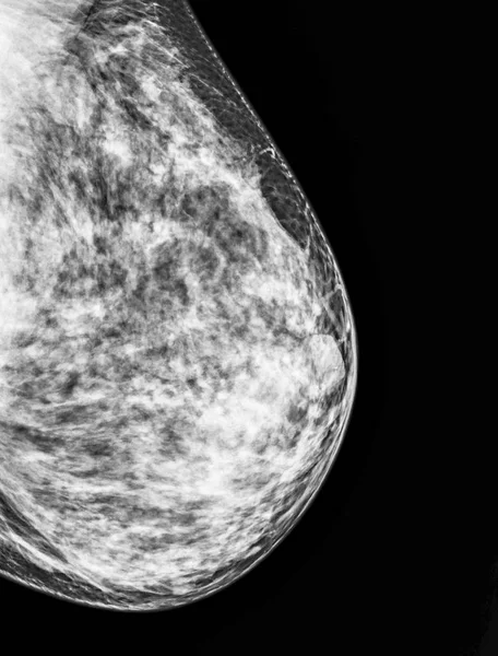 Mammography, x-ray of Breast — Stock Photo, Image