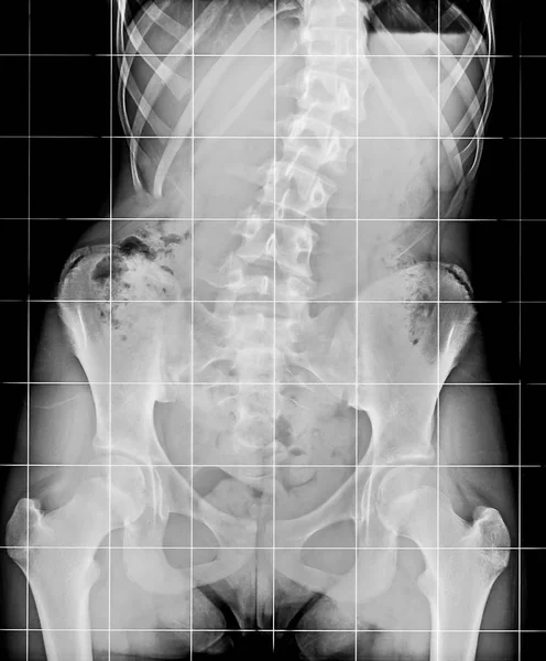 Röntgenfoto van de wervelkolom en het bekken. — Stockfoto