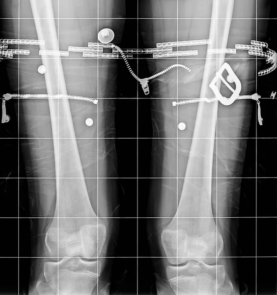 X-Ray of the knees — Stock Photo, Image