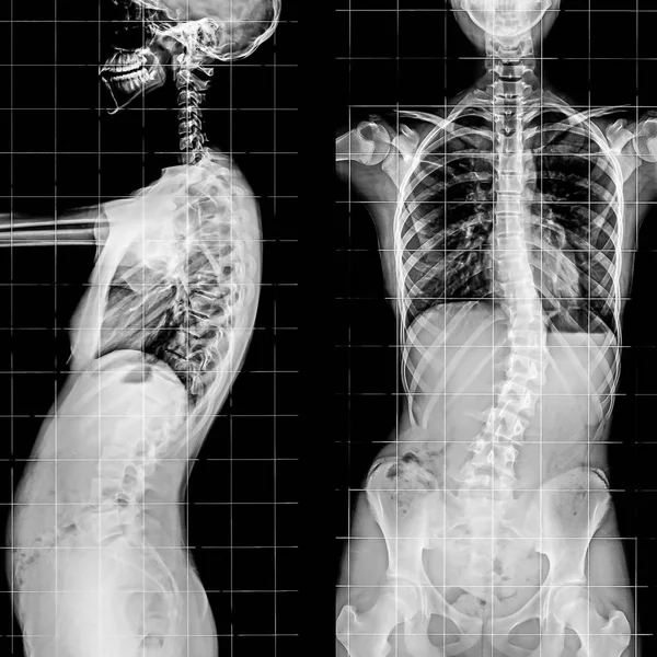 Рентген позвоночника и позвоночника . — стоковое фото