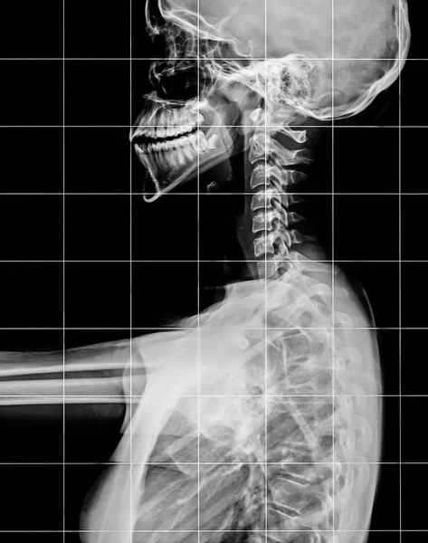 Рентген позвоночника и черепа — стоковое фото