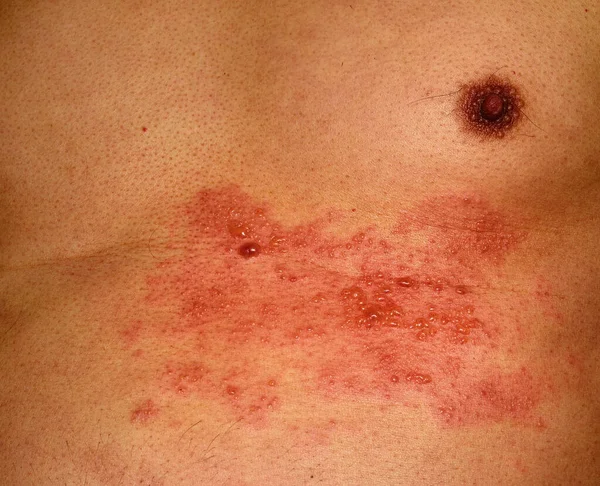 Shingles - herpes zoster — Stock Photo, Image